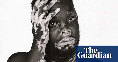 Embracing vitiligo: Ugandan artist dispels skin stigma with portraits
