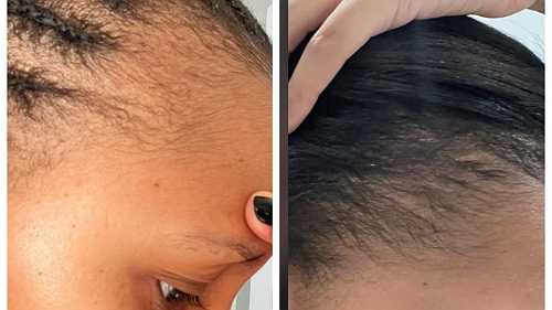 Black Women Using Rogaine to Regrow Their Edges Share Amazing Before, After Pics on Tiktok