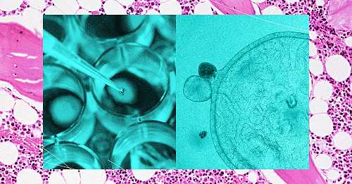 Bone Marrow Donors Can Be Hard to Find. One Company Is Turning to Cadavers