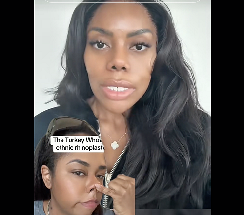 Why The "Ethnic" Nose Job Is The New BBL For Black Women | The Root