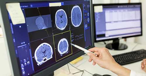 New study finds link between traumatic brain injuries and brain cancer risk