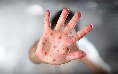 North Carolina Confirms First Measles Case of 2025, Urges Vaccination