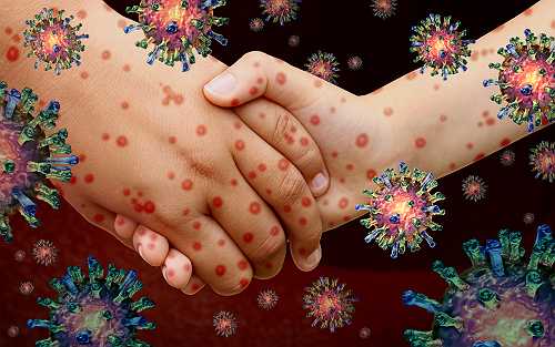 Measles Cases in U.S. Hit 33-Year High in 2025 Outbreak