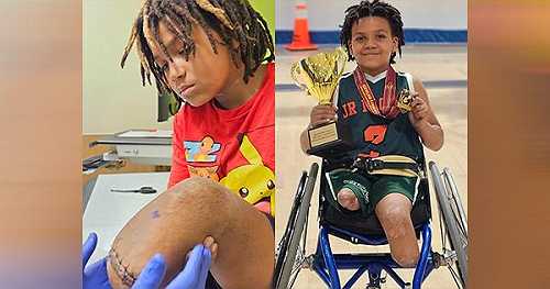 7-Year-Old Boy Loses Both Legs After Surviving Life-Threatening Flu