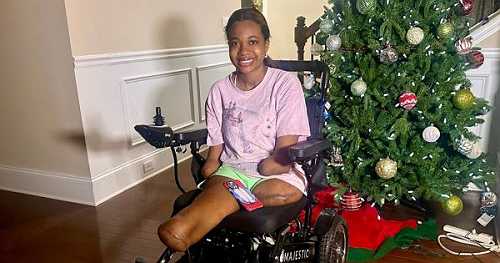 Black Woman Who Lost Both Arms and Legs is Now Walking Again