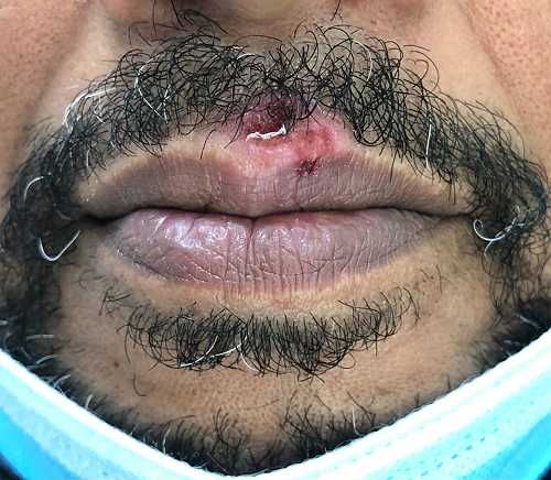 3 herpes triggers you can avoid starting today