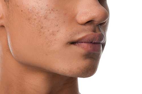 Natural ways to clear hormonal acne at home that work