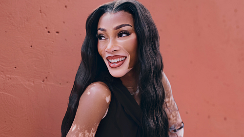 &nbsp;Beyond the skin: Winnie Harlow on vitiligo, visibility, and the power of choice
