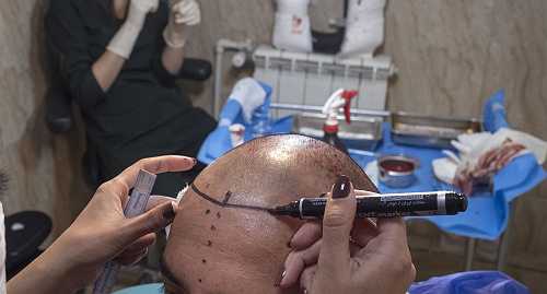 Prayers Up! Man Dies During Prep Phase Of His Second Hair Transplant Surgery In Turkey